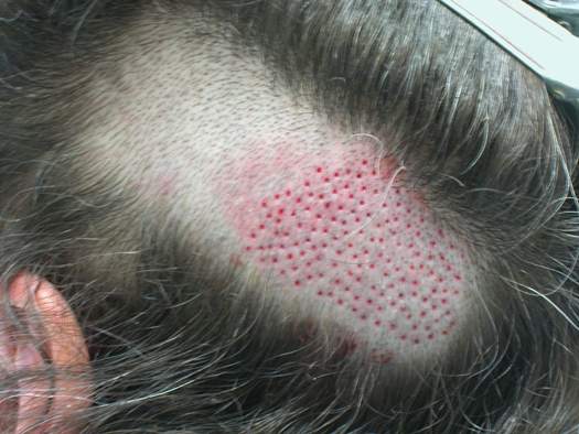 Bradley Wolf MD FUE extractions..jpg