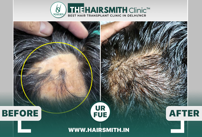 burn scar hair transplant result - the hairsmith clinic - best hair transplant clinic.JPG