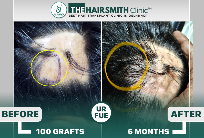 burn scar result - hairsmith hair transplant results.JPG
