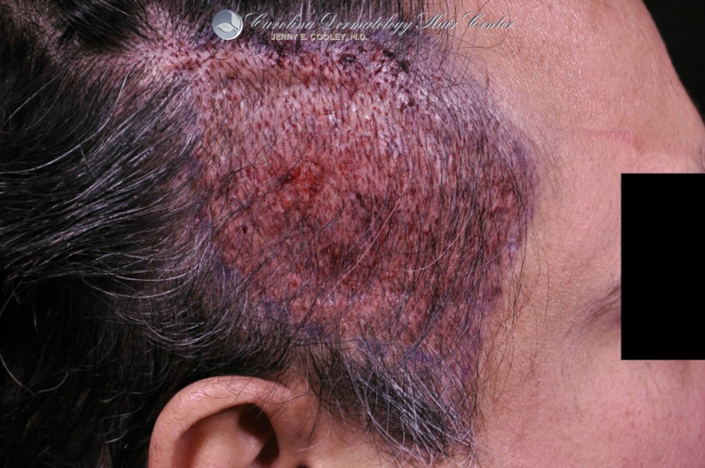 cancer-scar-hair-transplant-repair-Dr Jerry Cooley (2).jpg