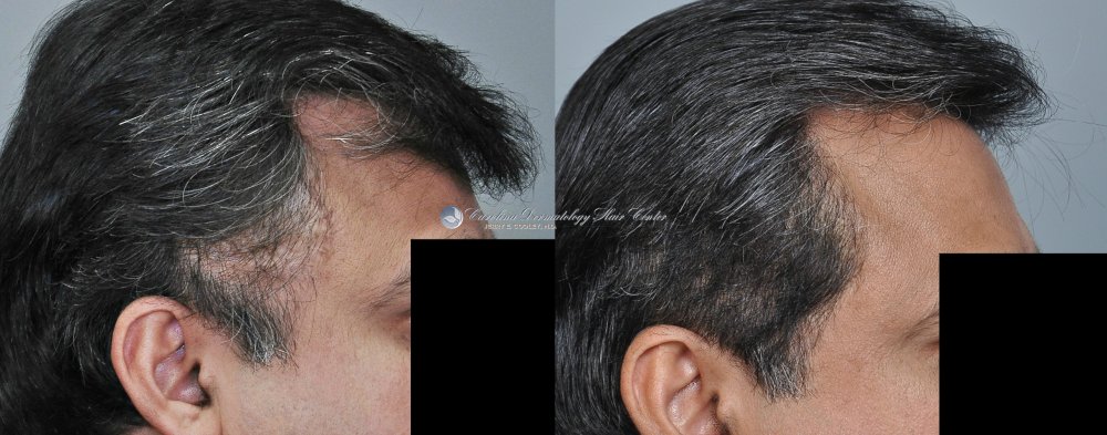 cancer-scar-hair-transplant-repair-Dr Jerry Cooley (3).jpg