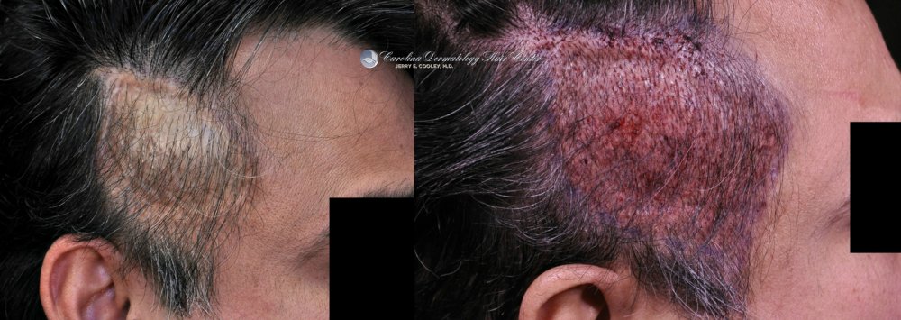 cancer-scar-hair-transplant-repair-Dr Jerry Cooley (4).jpg
