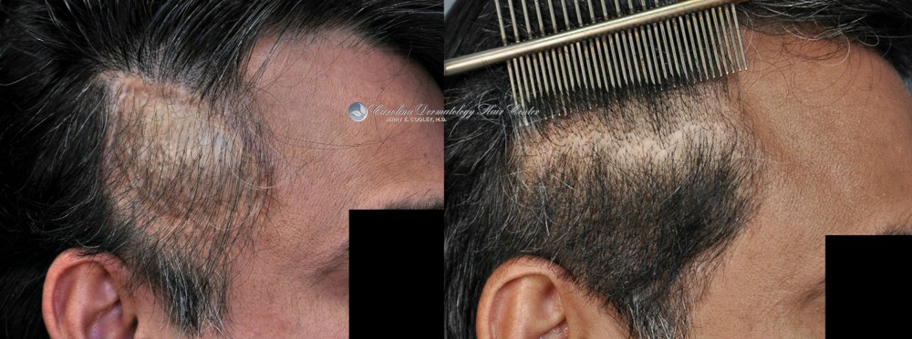 cancer-scar-hair-transplant-repair-Dr Jerry Cooley (5).jpg