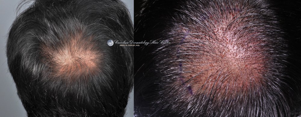 cancer-scar-hair-transplant-repair-Dr Jerry Cooley (6).jpg