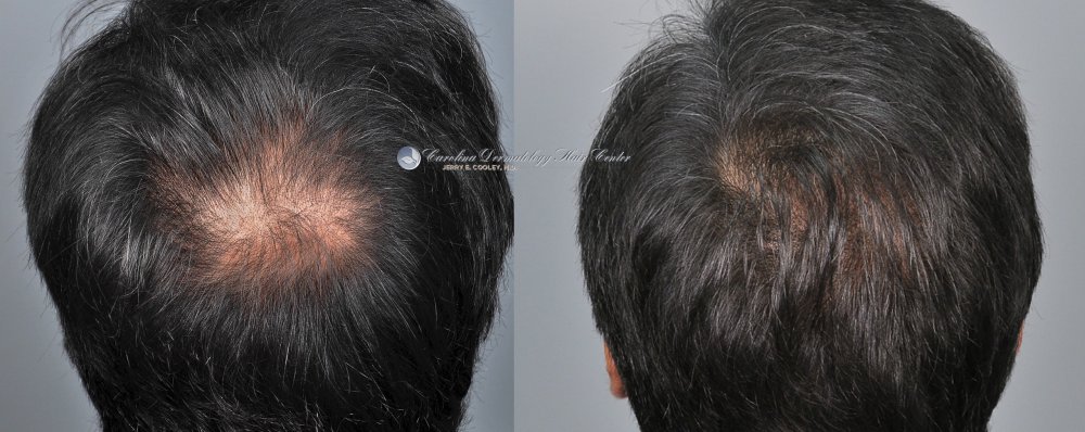 cancer-scar-hair-transplant-repair-Dr Jerry Cooley (7).jpg