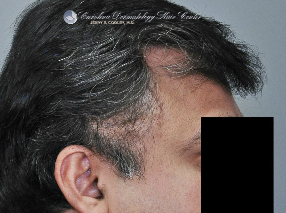 cancer-scar-hair-transplant-repair- Dr Jerry Cooley.jpg
