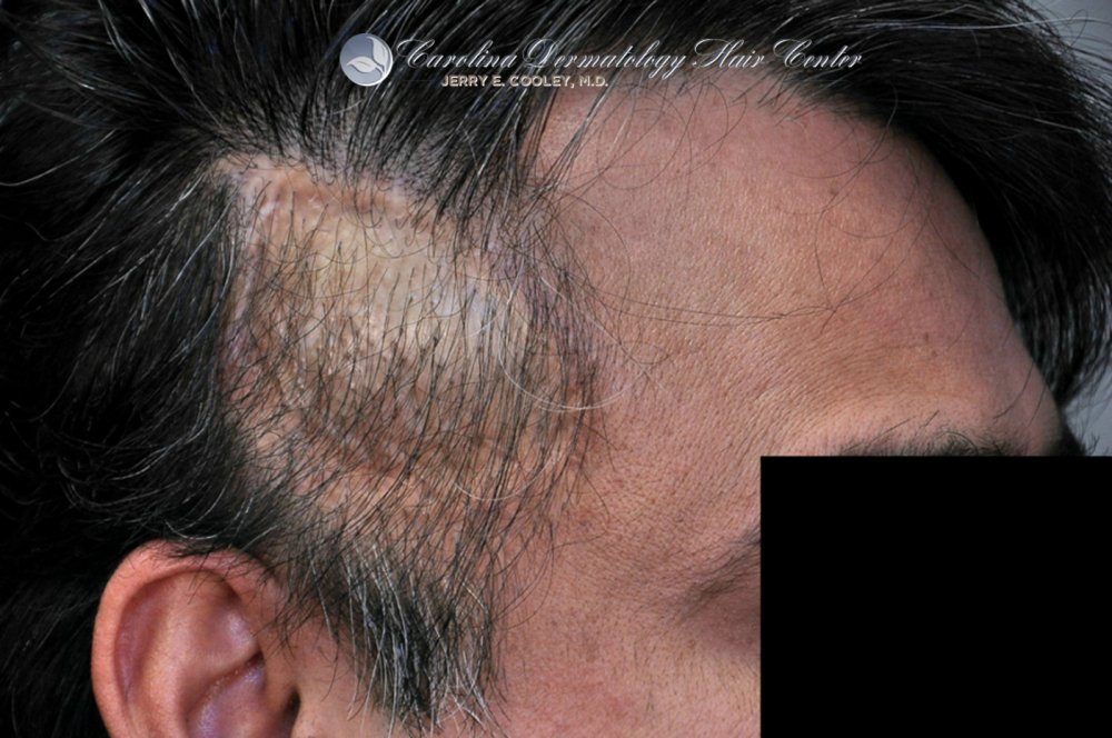 cancer-scar-hair-transplant-repair-Dr Jerry Cooley.jpg