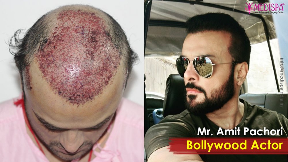 celebrity-hair-transplant-india-1.jpg