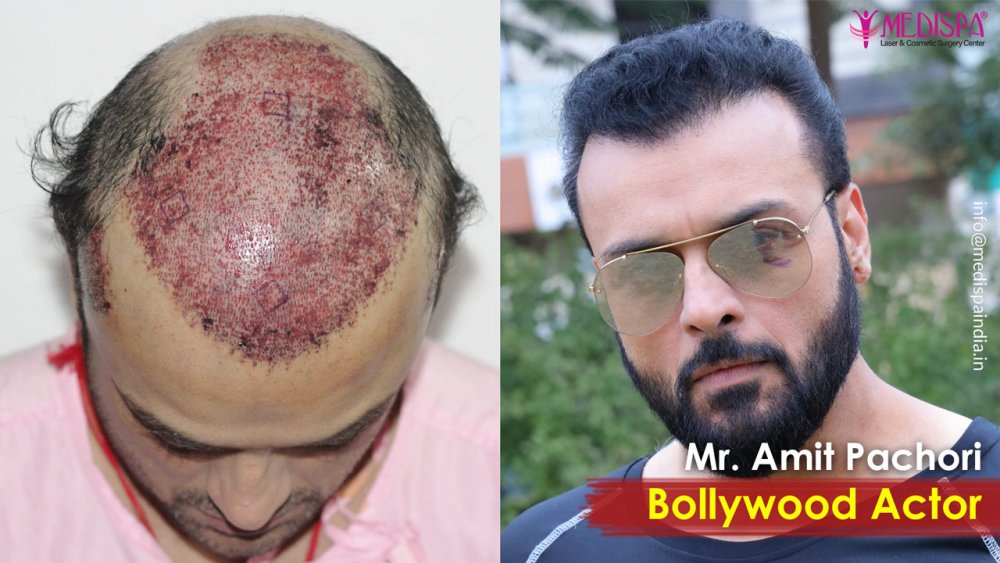 celebrity-hair-transplant-jaipur.jpg