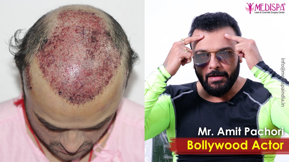 celebrity-hair-transplant-rajasthan.jpg