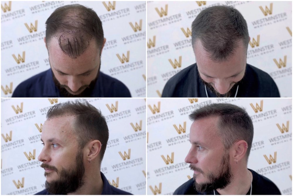 Christopher's 6 Months FUE Progress.jpg