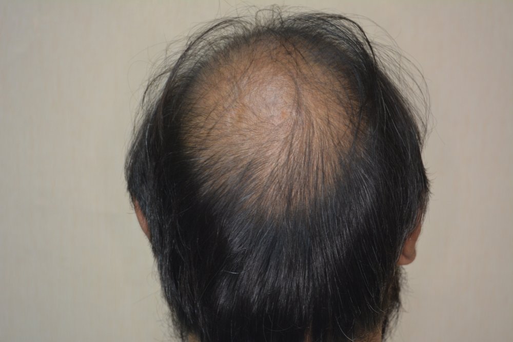 Clear crown hair loss view before.JPG