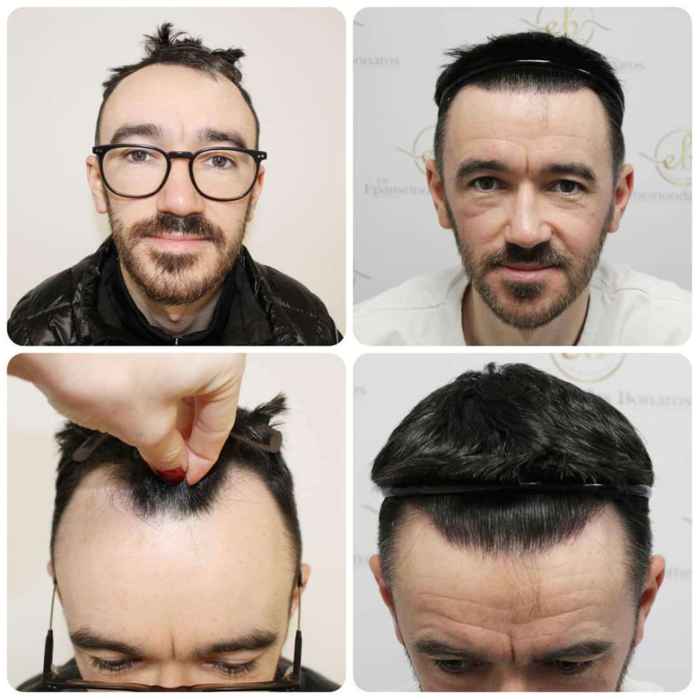 Copy of Hair-transplant-dr-bonaros-scotland (1).jpeg