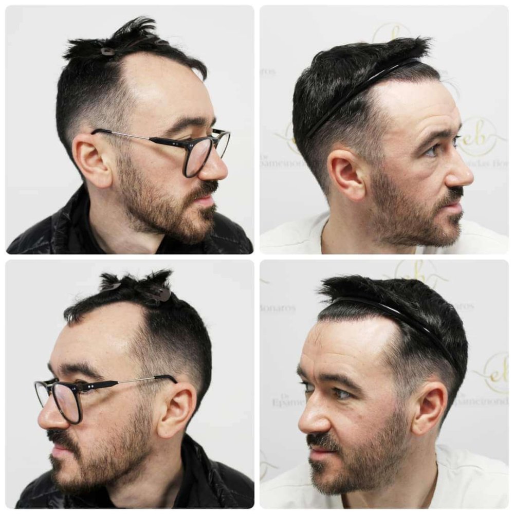 Copy of Hair-transplant-dr-bonaros-scotland.jpeg