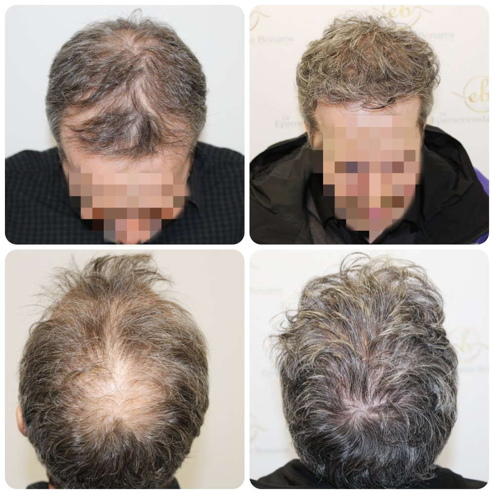 Copy of hair-transplant-glasgow-dr-bonaros.jpg