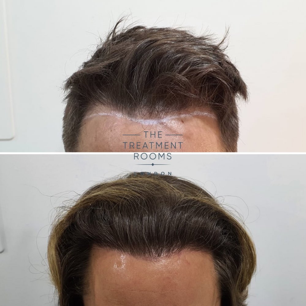 Corrective DHI hair transplant surgery hairline before and after.jpg