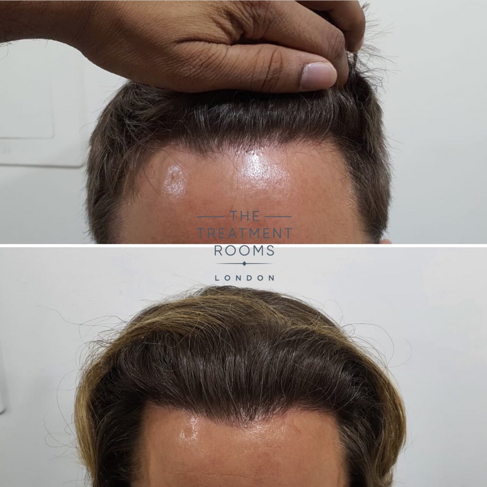 Corrective FUE hair transplant surgery hairline before and after.jpg