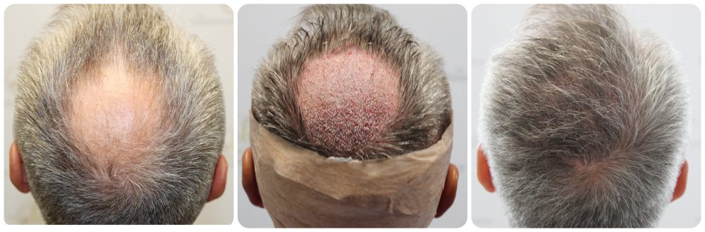 crown-hair-transplant-dr-bonaros-scotland (1).jpg