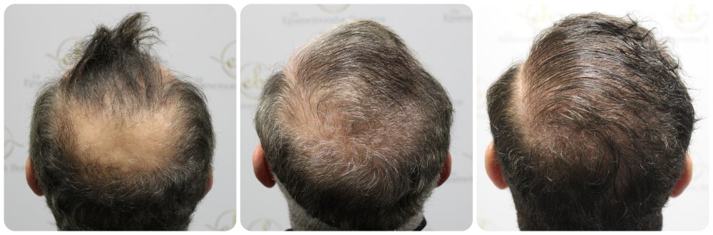 crown-hair-transplant-dr-bonaros-scotland (2).jpg