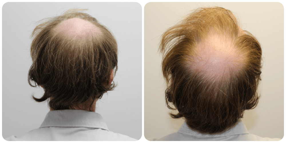 Crown-hair-transplant-glasgow-dr-bonaros.png