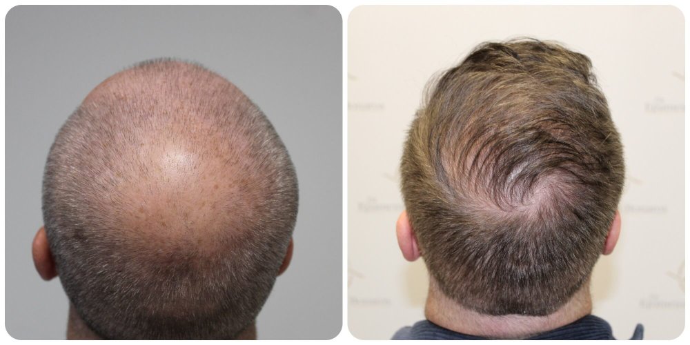 crown-hair-transplant-glasgow.jpg