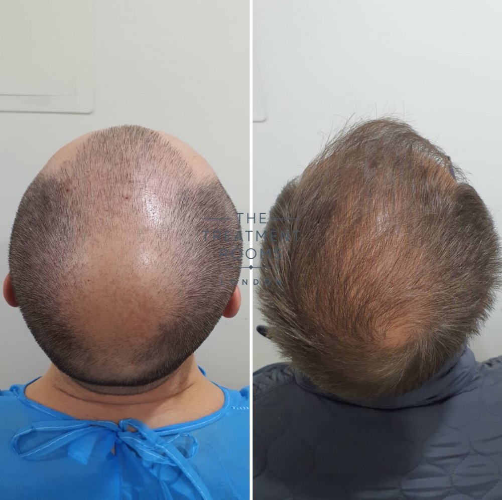 Crown hair transplant result 2000 grafts.jpg