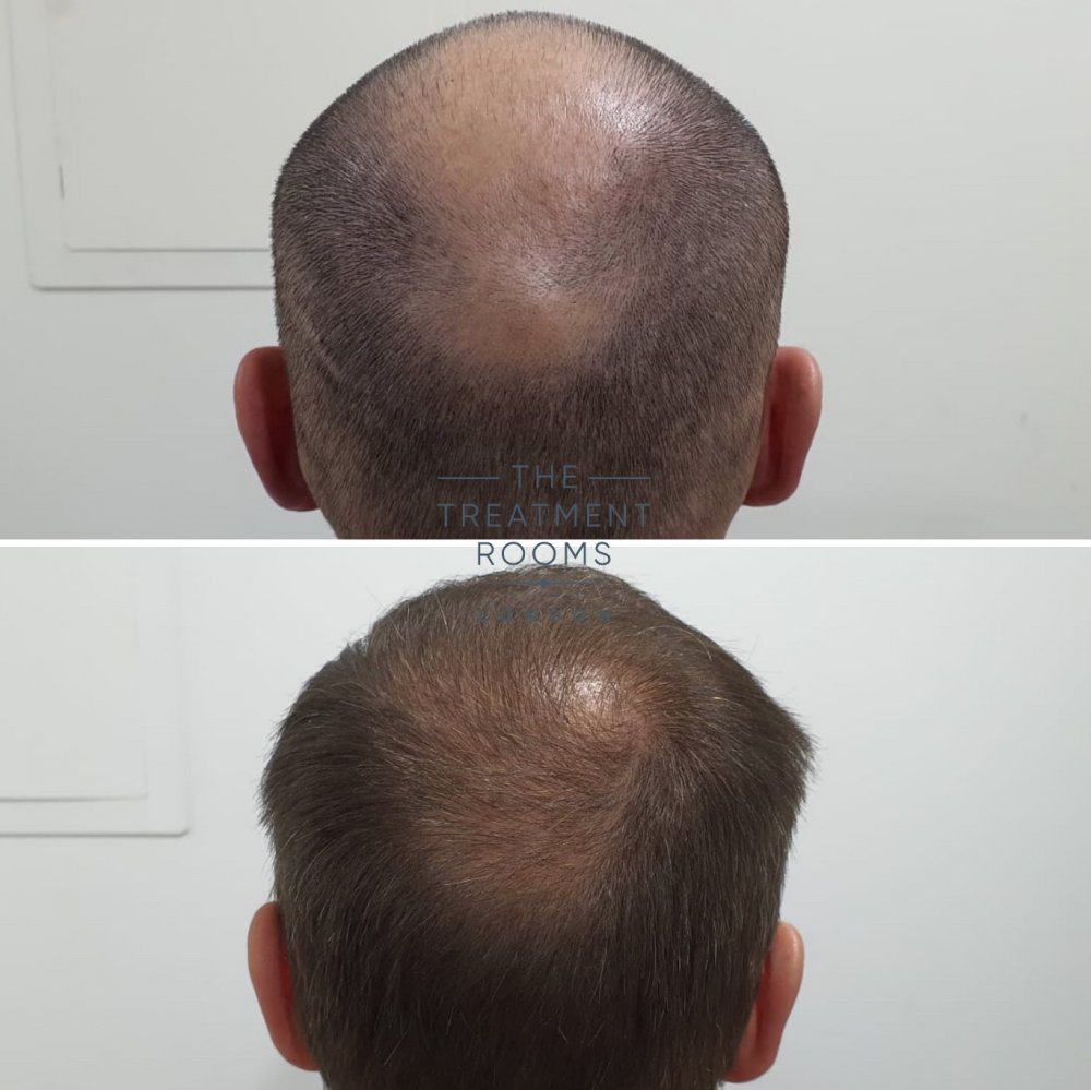 Crown hair transplant result.jpg