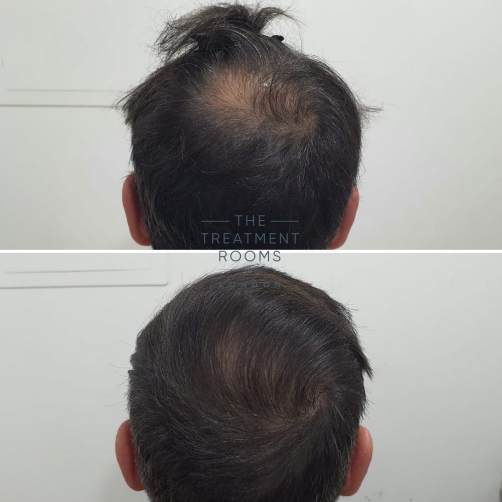 Crown Hair Transplant Result.jpg