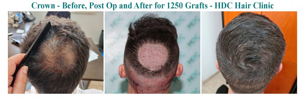 Crown  -  HT 7-04-22 for 1250 grafts.jpg