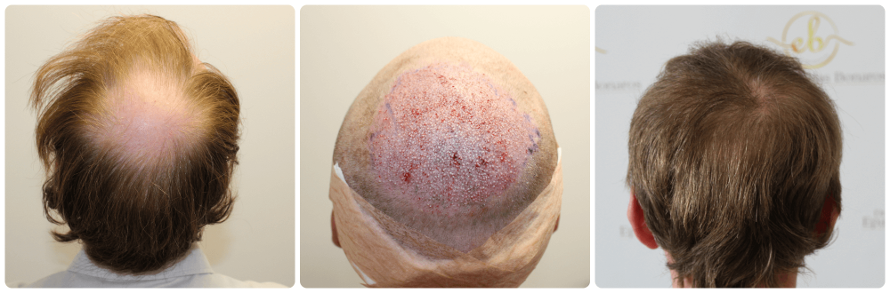 Crown-restoration-dr-bonaros-glagow-fue.png