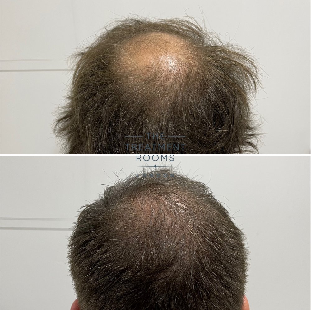 Crown transplant before and after 1762 grafts.jpg