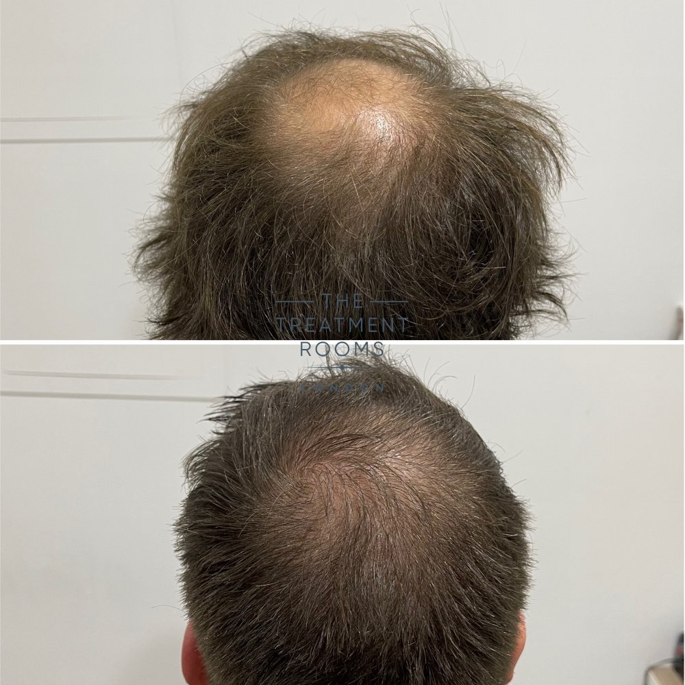 Crown transplant before and after.jpg
