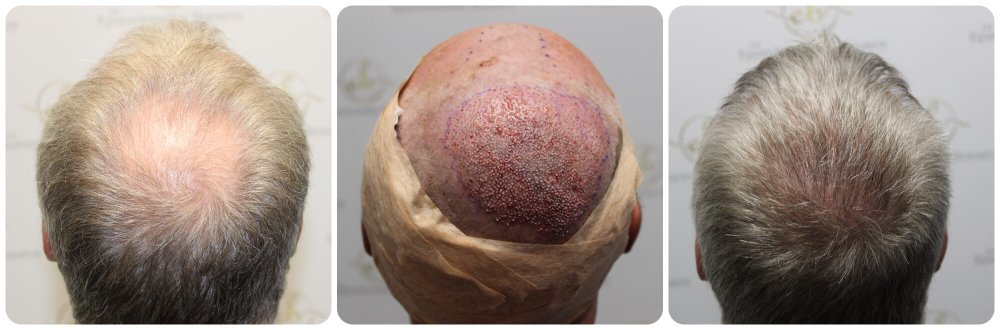 crown-transplant-dr-bonaros.jpg