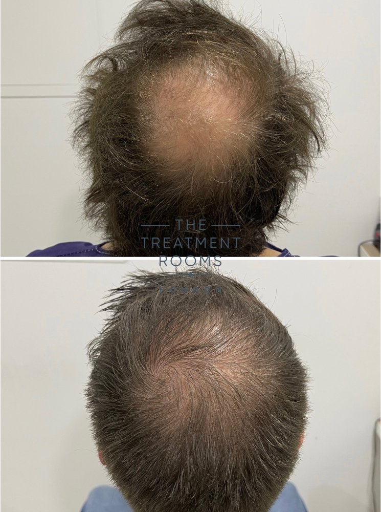 Crown transplant results 1762 grafts.jpg