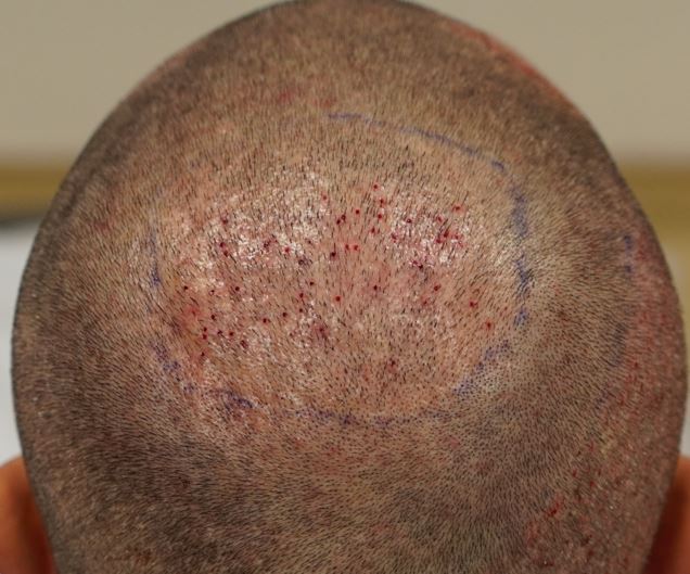 crown_post surgery.JPG