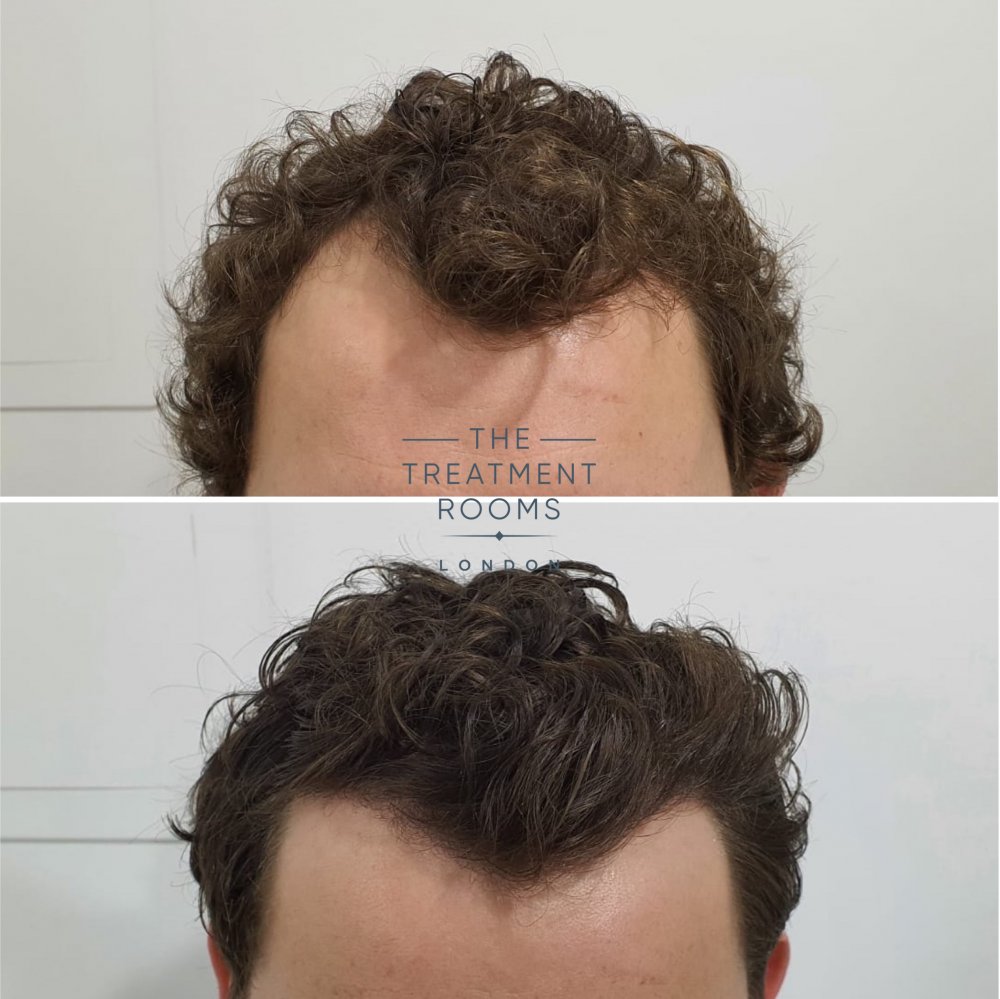 Curly hair FUE hair transplant before and after.jpg