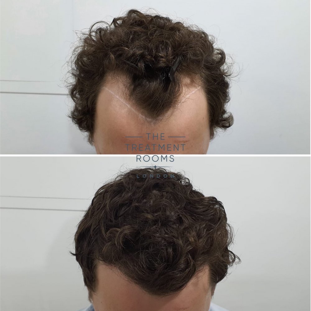 Curly hair FUE hair transplant.jpg