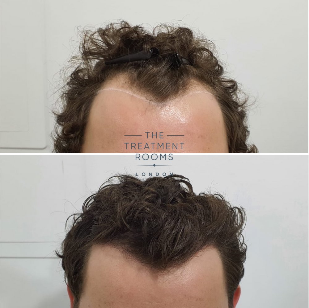 Curly hair FUE hair transplant London.jpg