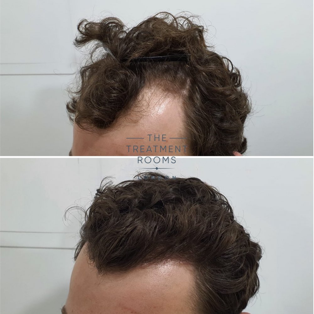 Curly hair FUE hair transplant result.jpg