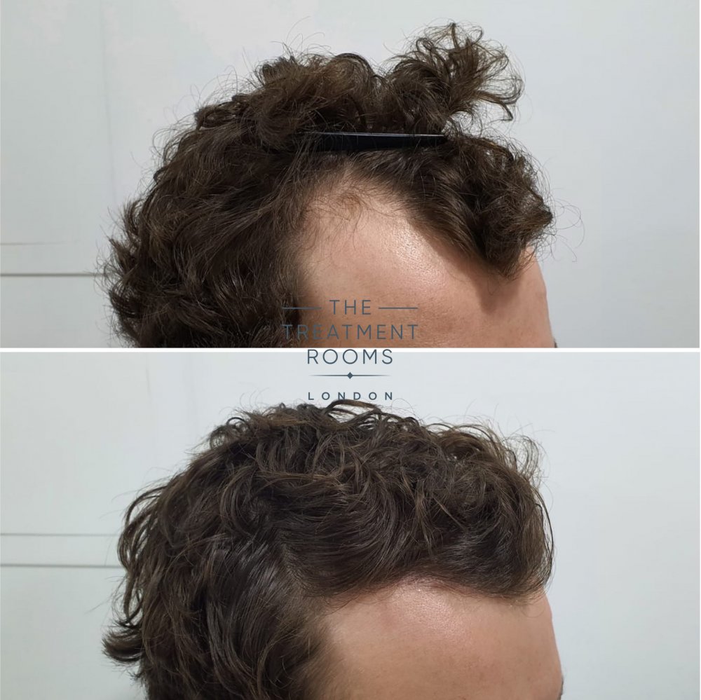 curly hair temple hair transplant.jpg