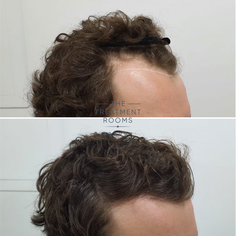 Curly hair transplant London.jpg