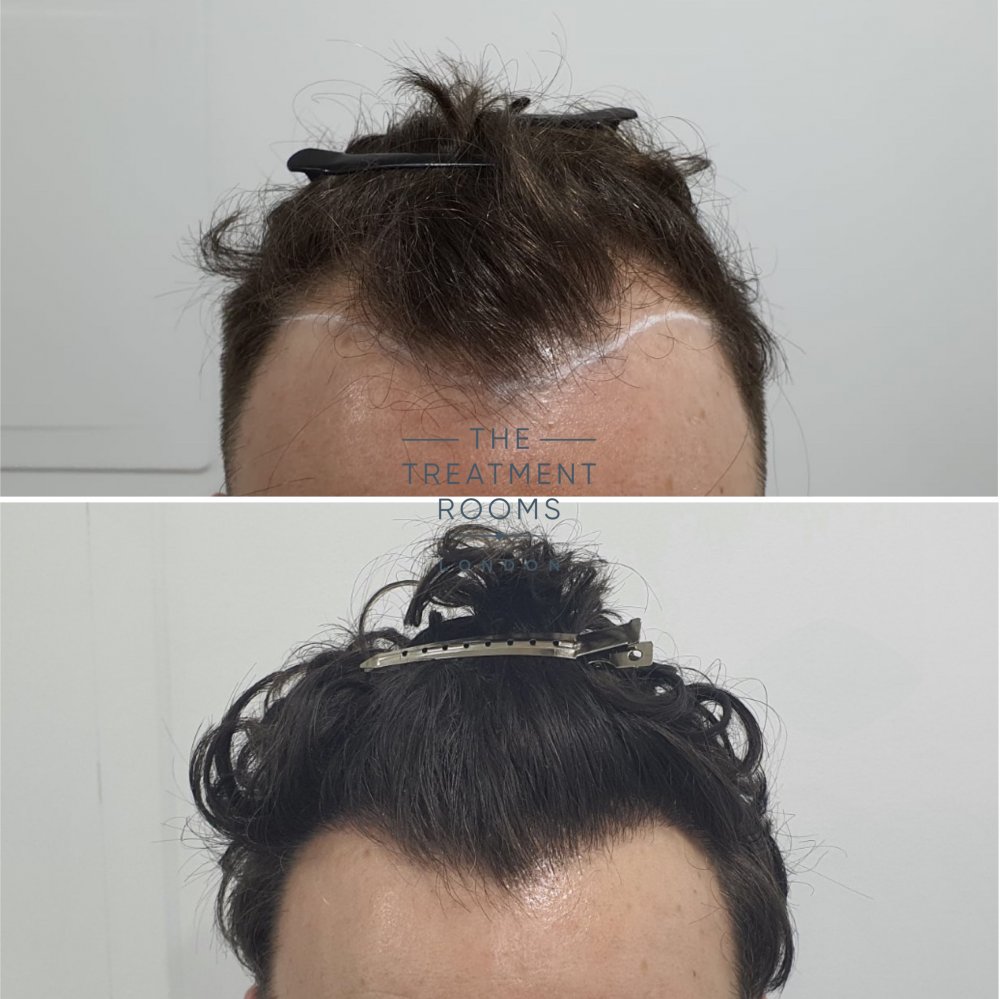 curly hair transplant result 1194 grafts.jpg