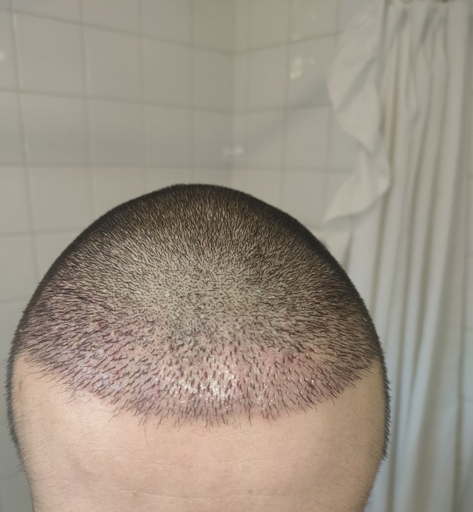 Day 7 first wash fron.jpg