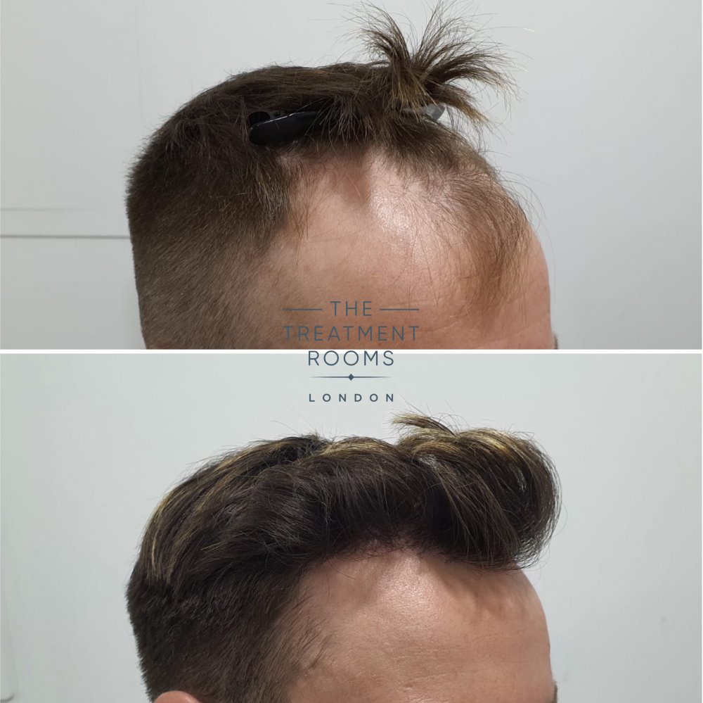 dhi hair transplant before and after 1724 grafts.jpg