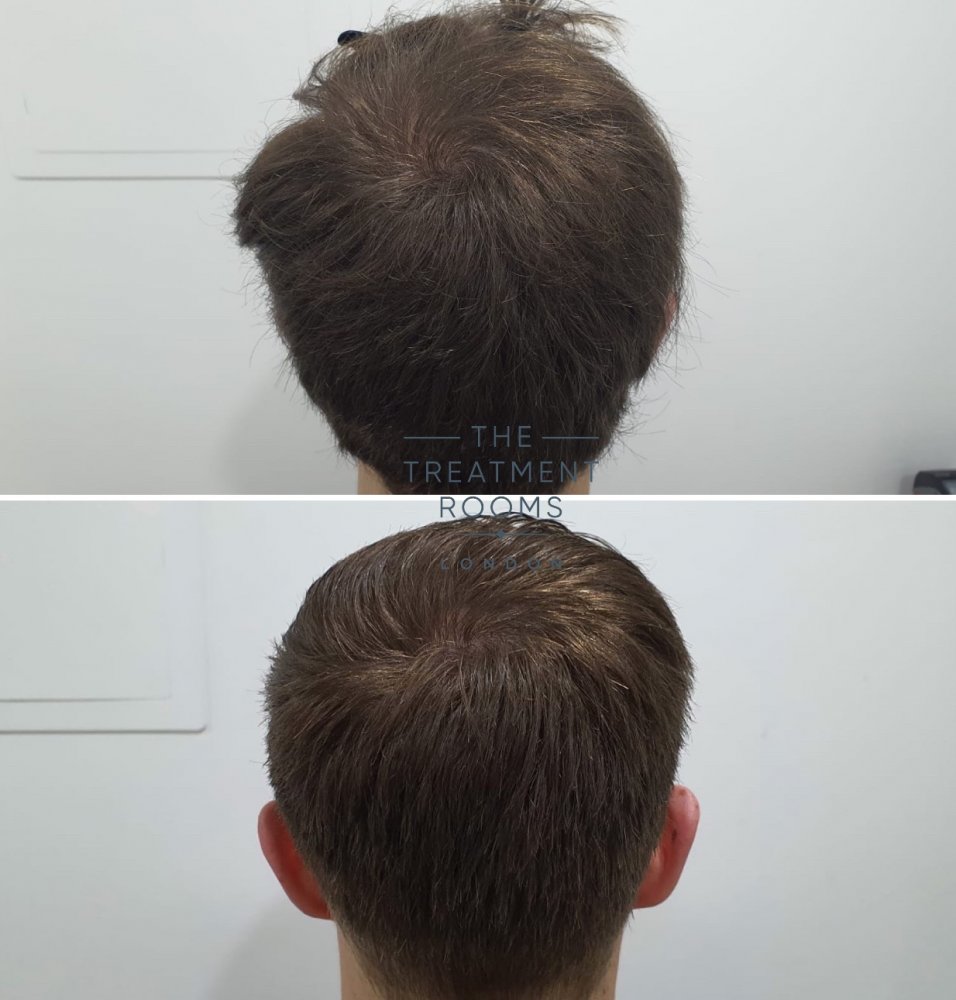 Donor area after 1200 grafts hair transplant.jpg