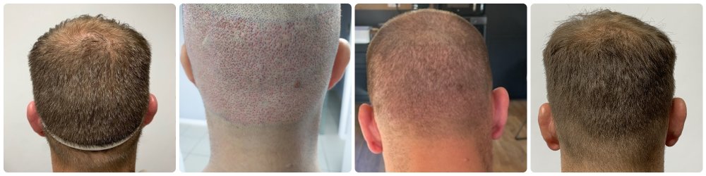 donor area after 2000 grafts by dr bonaros.jpg