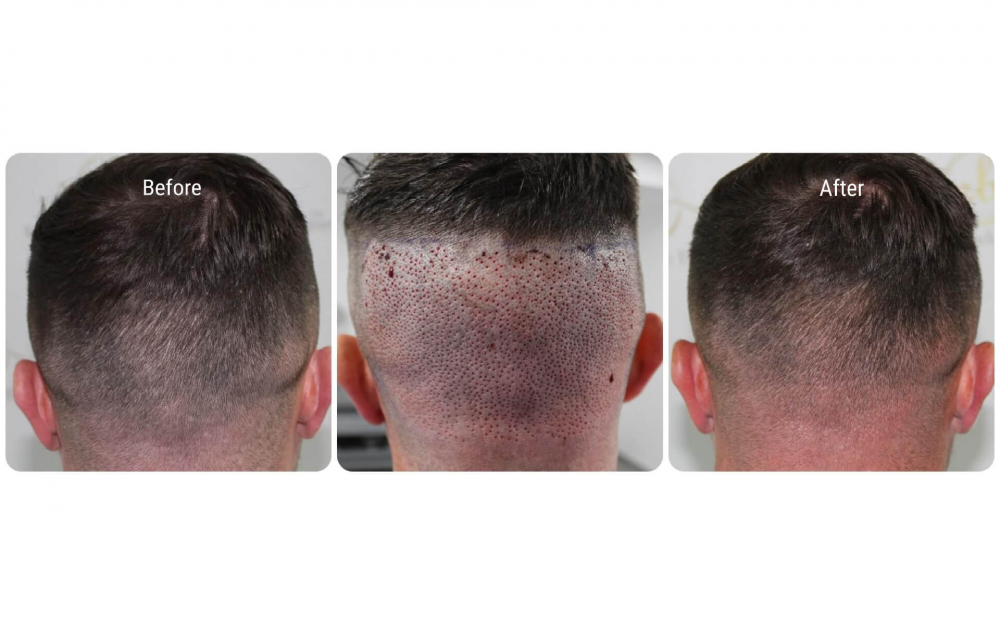 donor-area-after-fue-dr-bonaros-glasgow.png