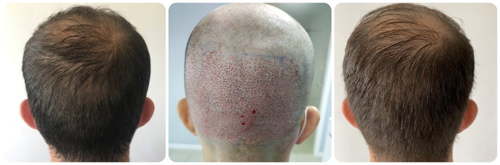 donor-area-healing-drbonaros-glasgow.jpg