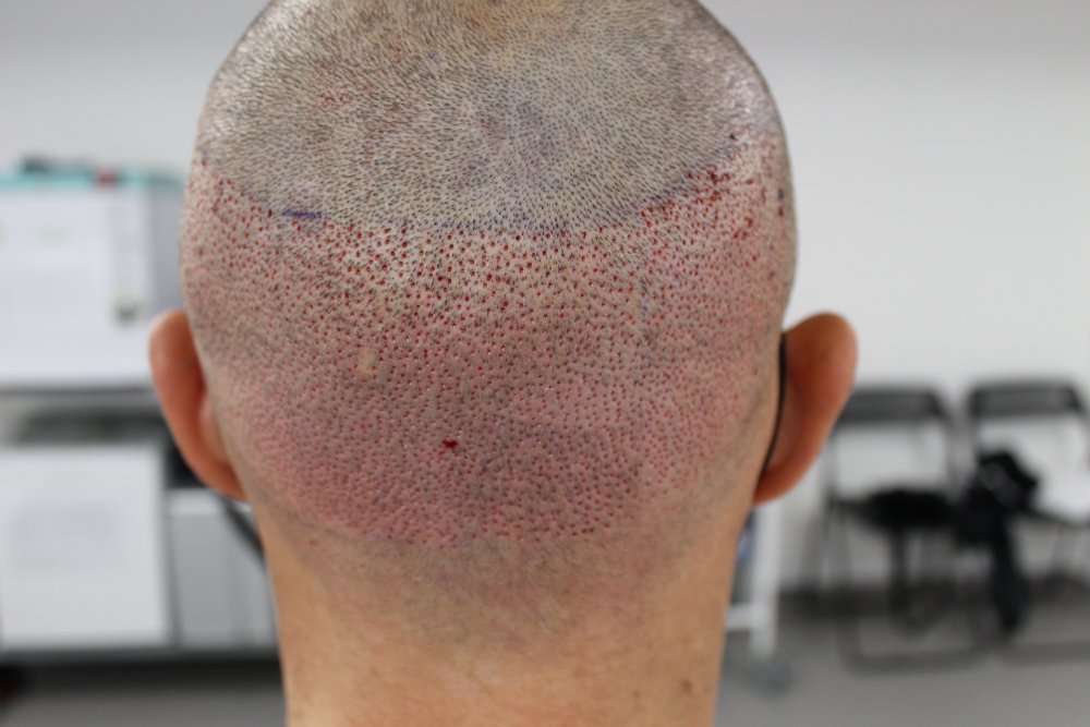 Donor-area-post-fue-dr-bonaros-scotland.jpg