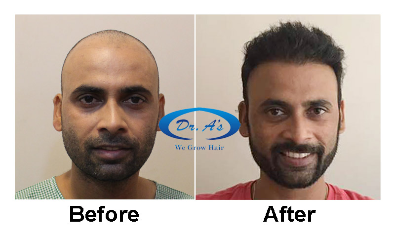 Dr Arvind Hair Transplant.jpg